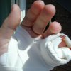 Hand Kaputter Kleiner Finger